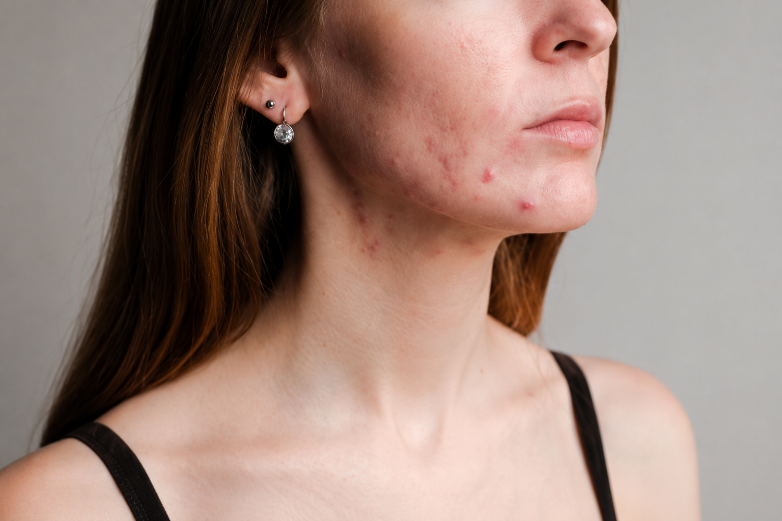 The Ultimate Guide to Understanding and Treating Acne