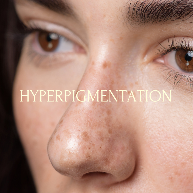 Hyperpigmentation