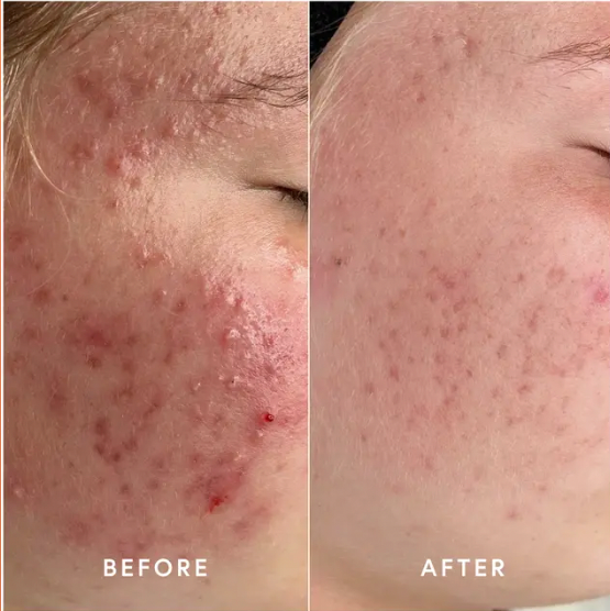 Your Skin Barrier: The Unsung Hero of Healthy Skin